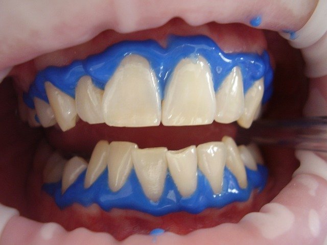 Enhance Your Looks And Get Whiter Teeth Now 1 enhance your looks and get whiter teeth now
